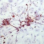 Lideri naționali și internaționali în lupta împotriva cancerului și a bolilor alergice se întrunesc la Timișoara